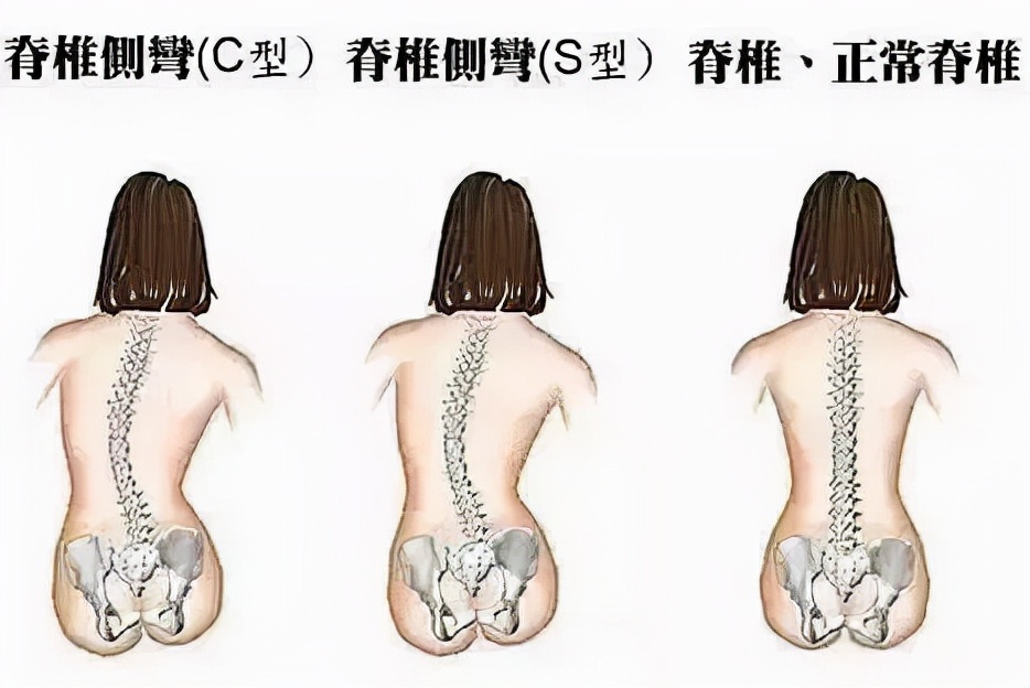 孩子脊椎變形的原因您知道多少？